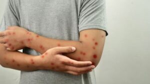 Nova variante da Mpox acende alerta para vigilância genômica em 2026