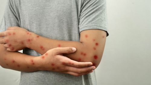 Nova variante da Mpox acende alerta para vigilância genômica em 2026